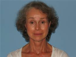 Facelift Before and After Photos by Paul Vanek, MD, FACS; Concord, OH