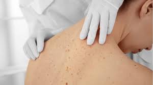 Η διάρκεια της κάθε συνεδρίας εξαρτάται από τις ανατομικές περιοχές που θα εφαρμοστεί το laser. Khlides Efhlides Dermalab