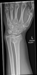 Image result for Pisiform Bone
