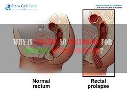 Image result for Rectal prolapse