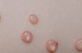 We did not find results for: Top 5 Homoeopathic Remedies For Molluscum Treatment