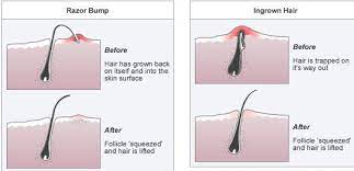 Ingrown hairs may be caused by improper shaving, waxing, or blockage of the hair follicle. Tricks To Avoid Ingrown Hair After Shaving Ingrown Hair Ingrown Hair Remedies Ingrown Hair Bump