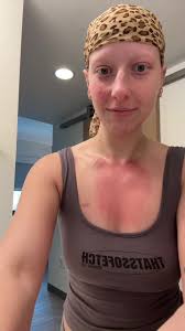 Cranial Facial Dysplasia Kayla