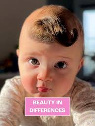 "My baby has a pre-cancerous birthmark