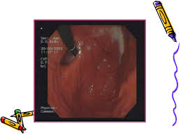 Brge afectează în proporție egală bărbații și femeile. Refluxul Gastro Esofagian Ppt Download