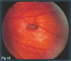 Eyedolatry Retinal Photography Review Chrpe Retinal Photography Medical Photography Photography Reviews