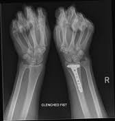 Wrist Clenched Fist View Radiology Reference Article Radiopaedia Org