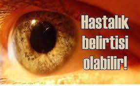 Acik Goz Renginde Sari Nokta Hastaligi Riski Daha Fazla Goz Rengi Nokta Kan Damarlari