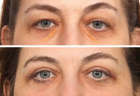 Xanthelasma Removal NYC | Dr. Jessica Lattman