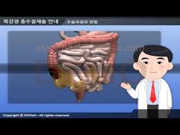 Comments on discussion boards from them will be hidden by default. ì‹œì—°ìš© C0078aako ë³µê°•ê²½ì¶©ìˆ˜ì ˆì œìˆ  ì•ˆë‚´ Youtube