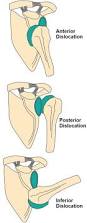 Image result for Chronic Shoulder Dislocation