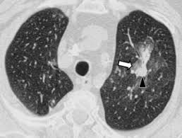Mucormycosis is a serious but rare fungal infection caused by a group of molds called mucormycetes, according to the u.s. Diagnose Der Pilzpneumonie In Der Thorax Ct Sciencedirect