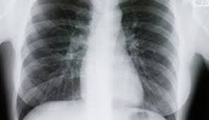 Image result for Lung Cancer