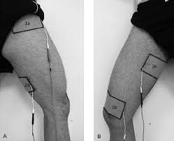 electrode placement for patterned electrical neuromuscular