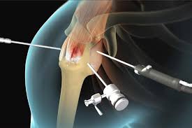 Image result for Rotator Cuff Rupture