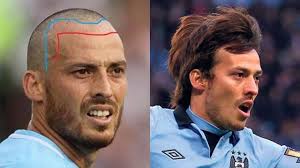 If you have a known intolerance to anesthetics, let your doctor know so that it can be taken into consideration. Celebrities With Hair Transplant Elon Musk And David Silva Rephair