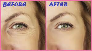 While eye bags come and go, there's no doubt that they're a nuisance. Remove Under Eye Wrinkles Fine Lines Permanently In 1 Week At Home Youtube Under Eye Wrinkles Eye Wrinkle Lines Under Eyes