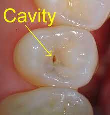 How I Healed My Child S Cavity Heal Cavities Health Tips Cavities