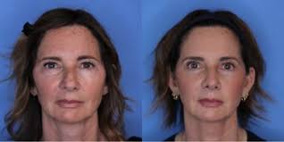 Thomas Romo, III, MD, Board Certified Facial Plastic Surgeon