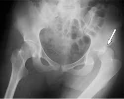 Maybe you would like to learn more about one of these? Dislocated Hip Symptoms Diagnosis And Treatments Hss