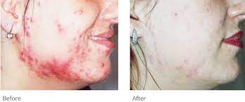Анализатор кожи mark vu new. Acne Treatment Treat Unwanted Acne With Ipl Technology