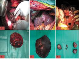 Surgeons make an incision across the right upper abdomen, below the after liver surgery. Parenchymal Sparing Hepatectomy As The New Doctrine In The Treatment Of Liver Metastatic Colorectal Disease Beyond Oncological Outcomes Anticancer Research