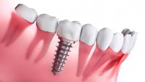 How to get a free dental implant. Dental Implant Stock Illustrations 14 234 Dental Implant Stock Illustrations Vectors Clipart Dreamstime