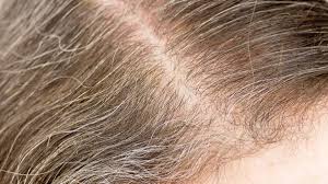 Another reason it could seem. How To Get Rid Of Gray Hair Getridofthings Com