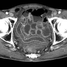Image result for Radiation Colitis