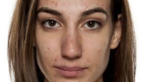 5 Cosas Que No Hay Que Decirles A Quienes Sufren De Acne Bbc News Mundo