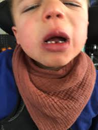 Fighting For Ian: Ian's battle with Epilepsy and Polymicrogyria