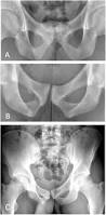 Image result for Pubic Apophysitis