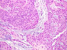 Image result for Glomus tumor