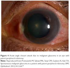 The loss of sight is usually gradual and a considerable amount of peripheral (side) vision may be lost before there is an awareness of any problem. The Early History Of Glaucoma The Glaucous Eye 800 Bc To 1050 A Opth