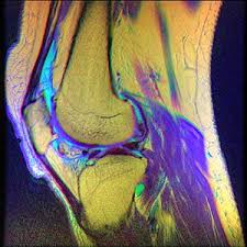 Chondromalacia Patellae Wikipedia