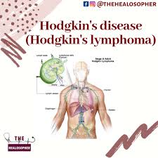 Select from premium hodgkin's lymphoma of the highest quality. The Healosopher Hodgkin S Disease Hodgkin S Lymphoma Facebook