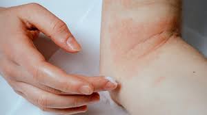 Image result for Atopic eczema atopic dermatitis