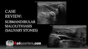 Image result for Sialolithiasis
