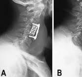 Titanium cage reconstruction after cervical corpectomy in ...