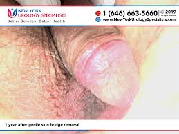 رسومات ومعرض صور الغشاء بين القضيب وكيس الصفن: قبل وبعد التصحيح - Penis  Wellness Center of North America in NYC