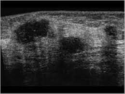 Breast And Axilla 5 2 Malignant Breast Lesions Case 5 2 7 Spreading Of Breast Cancer Multifocal And Multicentric Breast Cancer Ultrasound Cases
