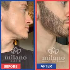 Sakal Ekimi Fiyatları İstanbul