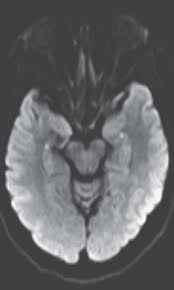 Image result for Transient Global Amnesia