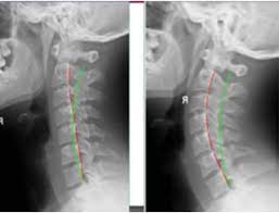 Check spelling or type a new query. Rectificacion Cervical Debe Corregirse