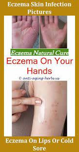 What Is Anti Aging Medicine Antiagingnatural Product Id 3328970565 Medicationstotreateczema Anti Itchcreams Face Eczema Eczema Rash Treatment