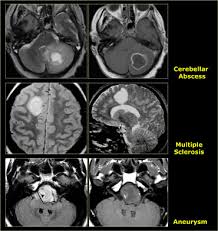 Image result for Brain Lesion