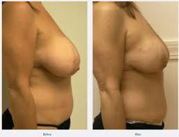 But breast reduction surgery, although quite common, is often misunderstood. No Scar Breast Reduction Guilford Connecticut The Langdon Center