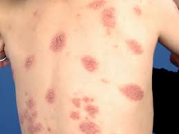Image result for Eczema nummulare