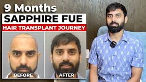 Sapphire FUE Hair Transplant Results Client Testimonial.