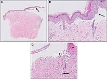 Bullous Pemphigoid Wikipedia The association between impetigo, insect bites and air temperature: bullous pemphigoid wikipedia